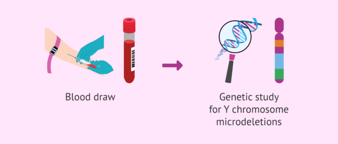 Imagen: How are Y chromosome microdeletions diagnosed?
