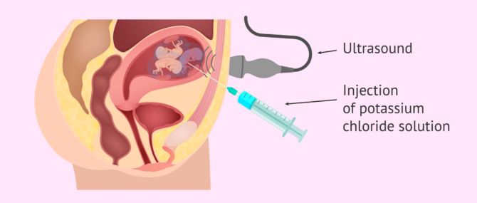 Imagen: How is multifetal reduction performed