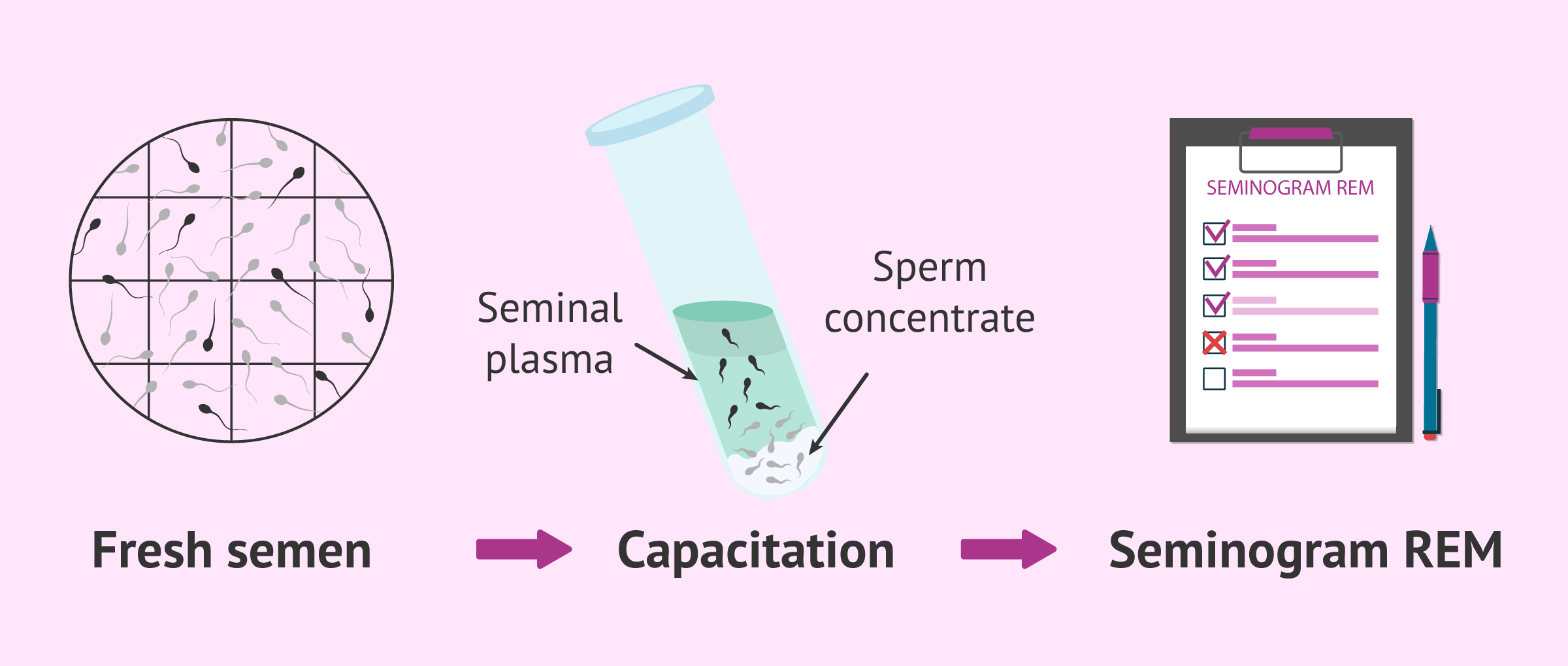 Sperm capacitation and MSC semen analysis