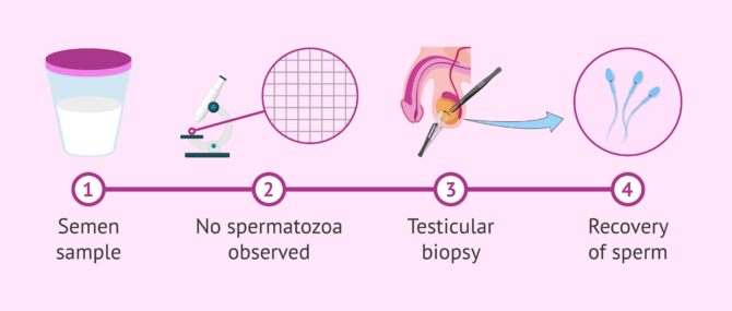 Imagen: Recovery of sperm with testicular biopsy
