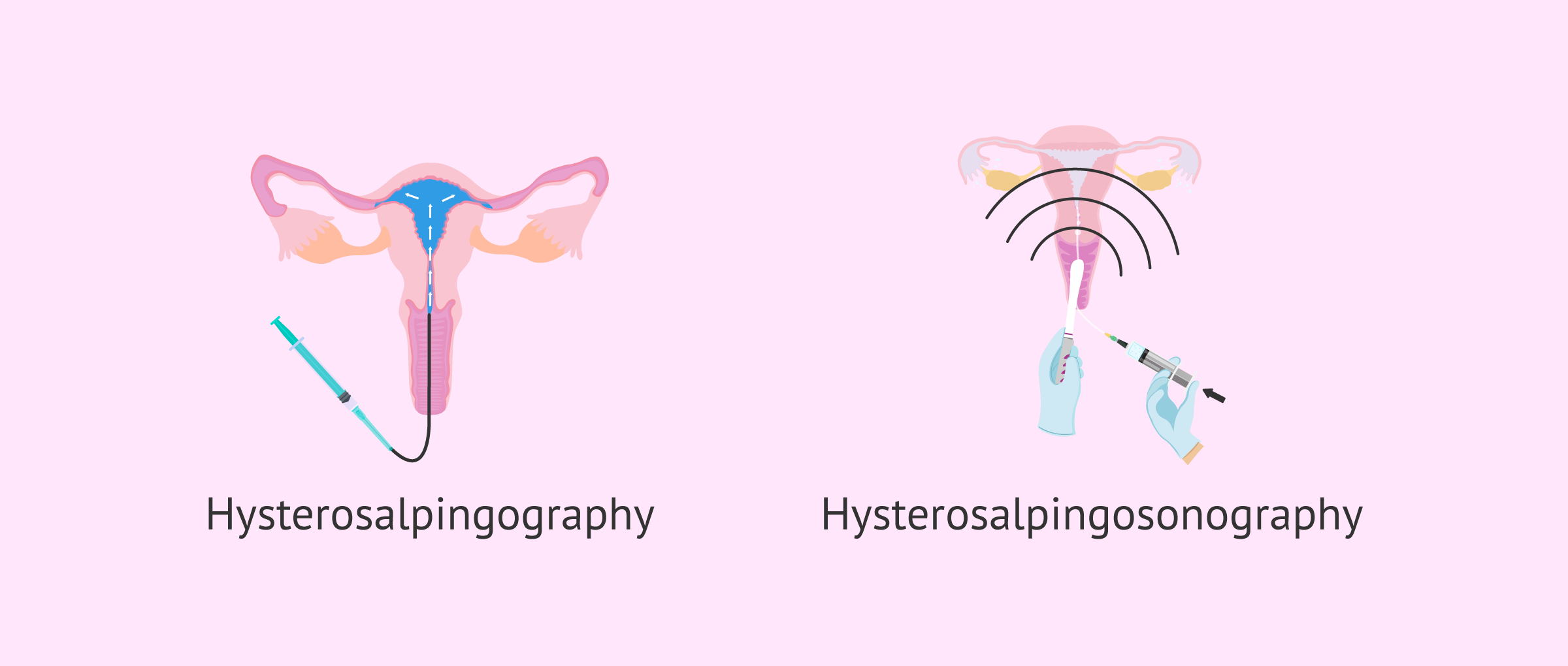 Imagen: Tests to check tubal patency