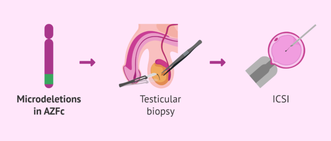 Imagen: Assisted reproductive techniques for Y chromosome microdeletions