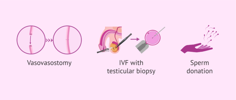 Vasectomy Can You Still Get Pregnant