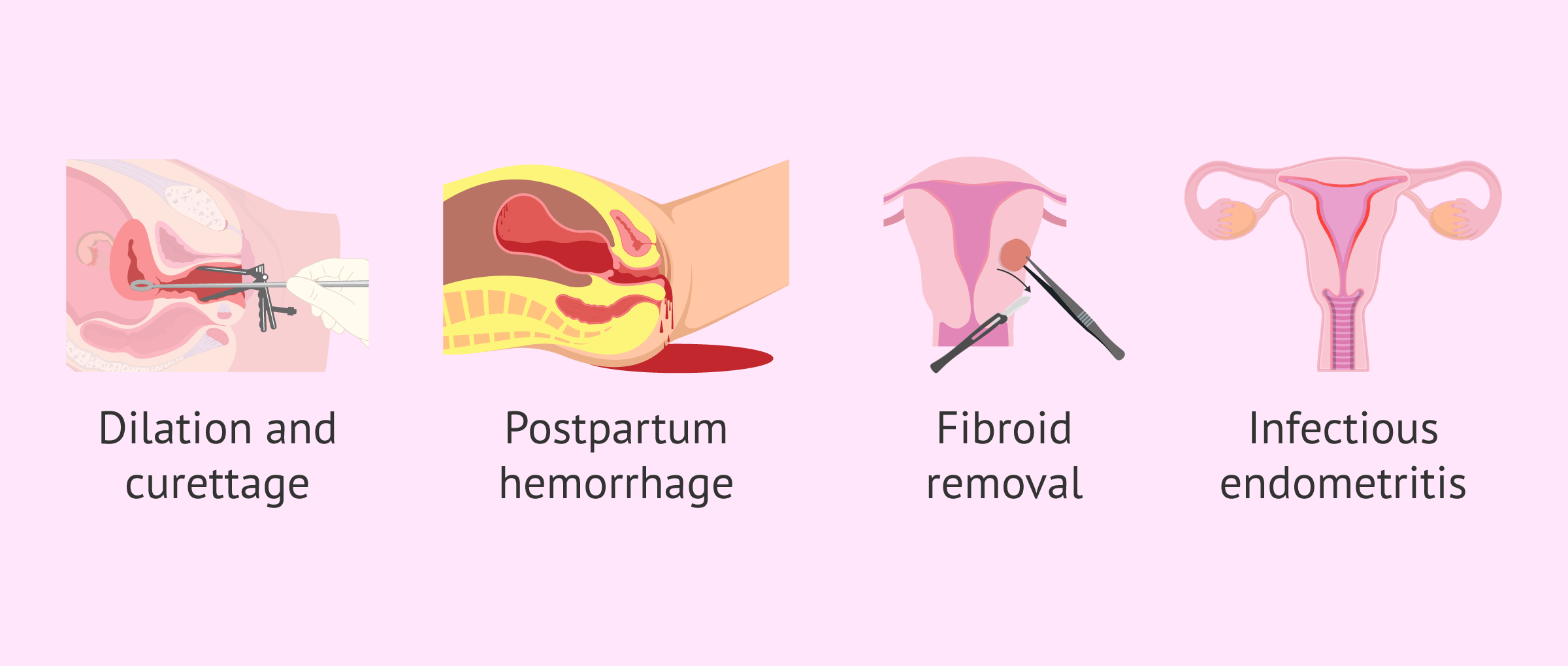 Imagen: Causes of uterine synechiae