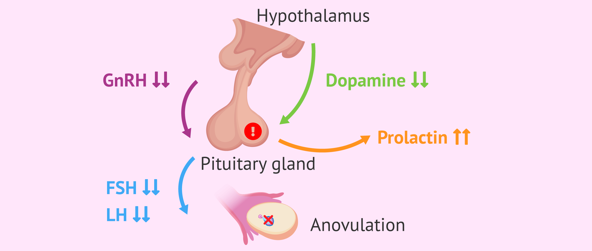 Imagen: Most common cause of hyperprolactinemia