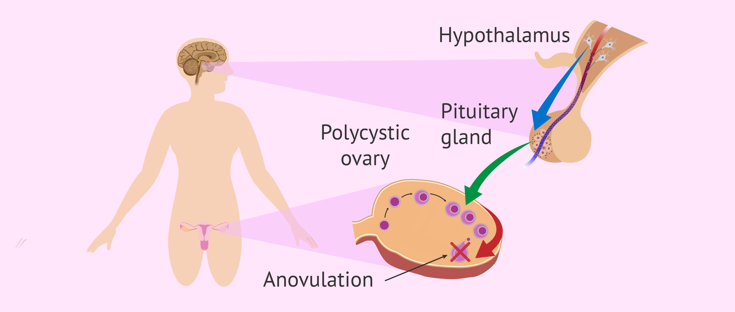 Imagen: Anovulation in women with PCOS