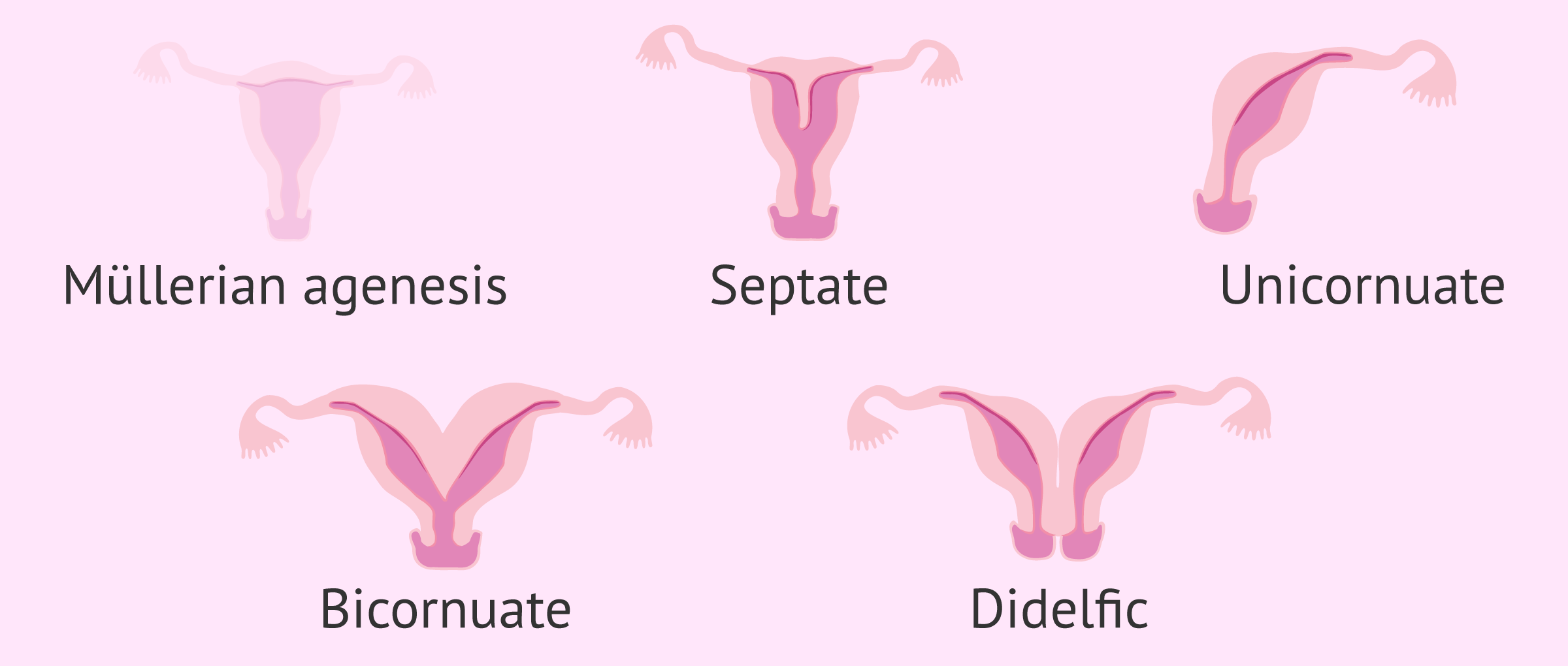 Imagen: Different uterine malformations