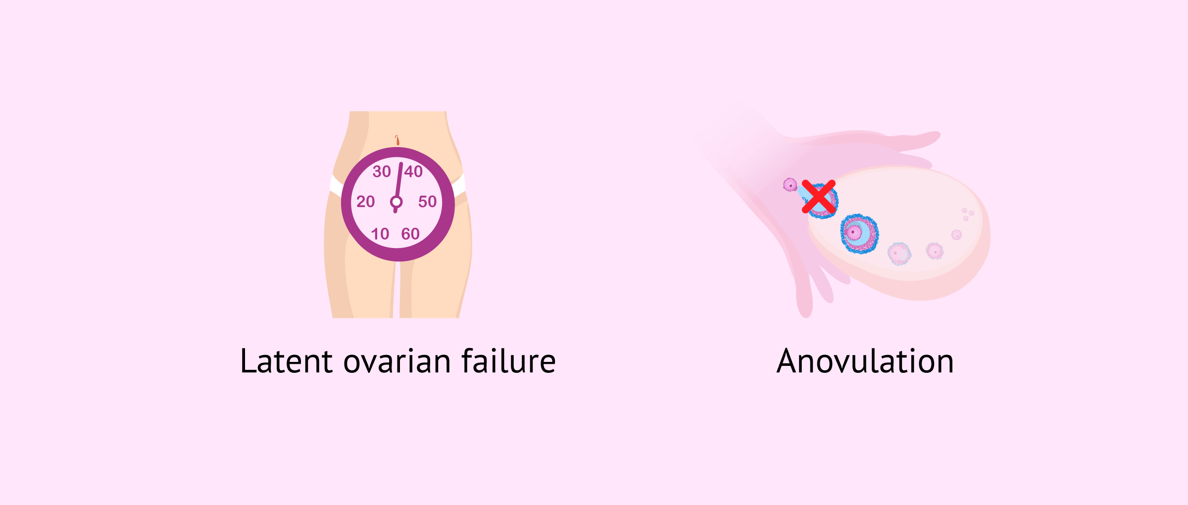 Imagen: Ovarian insufficiency and anovulation