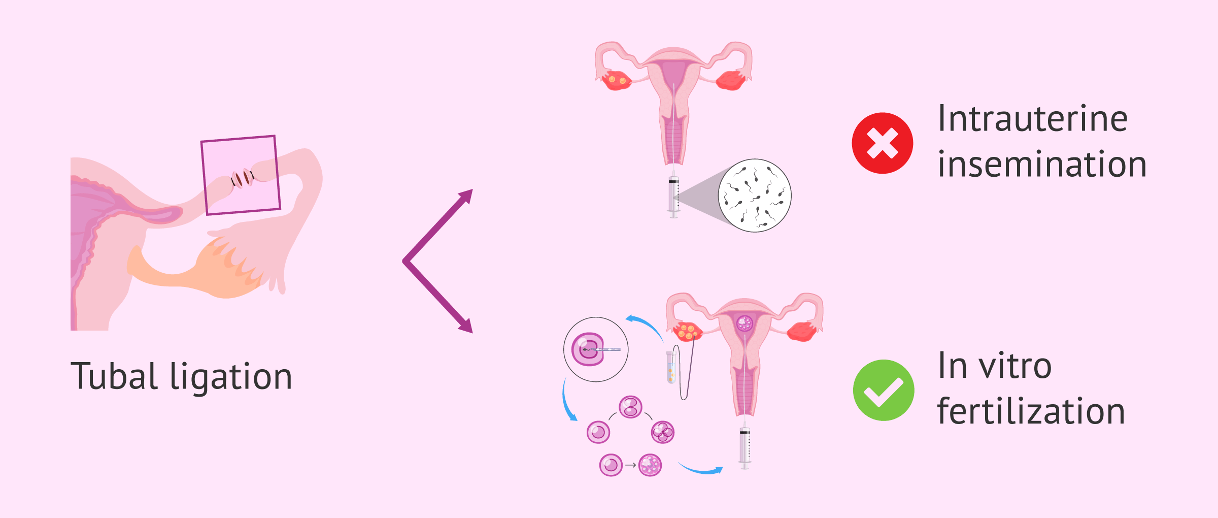 Assisted reproductive techniques after tubal ligation