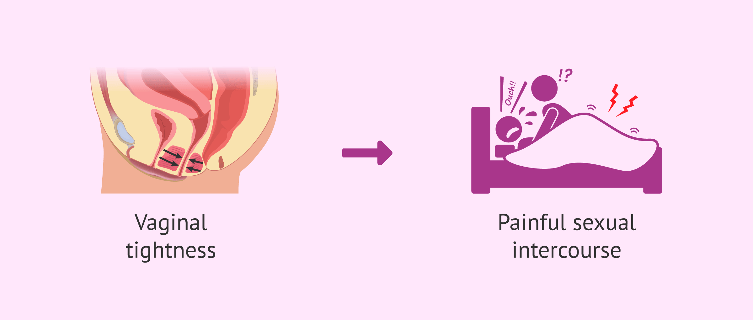 Imagen: Consequence of vaginismus in women