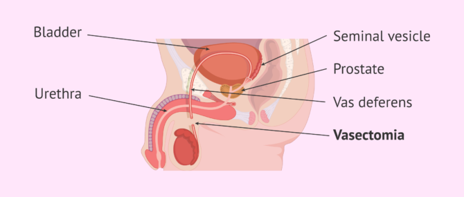 Imagen: Sectioning of the vas deferens in a vasectomy