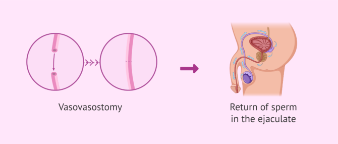 Imagen: Vasovasostomy to undo a vasectomy