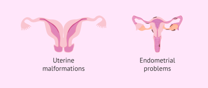 Imagen: Uterine reasons for female infertility