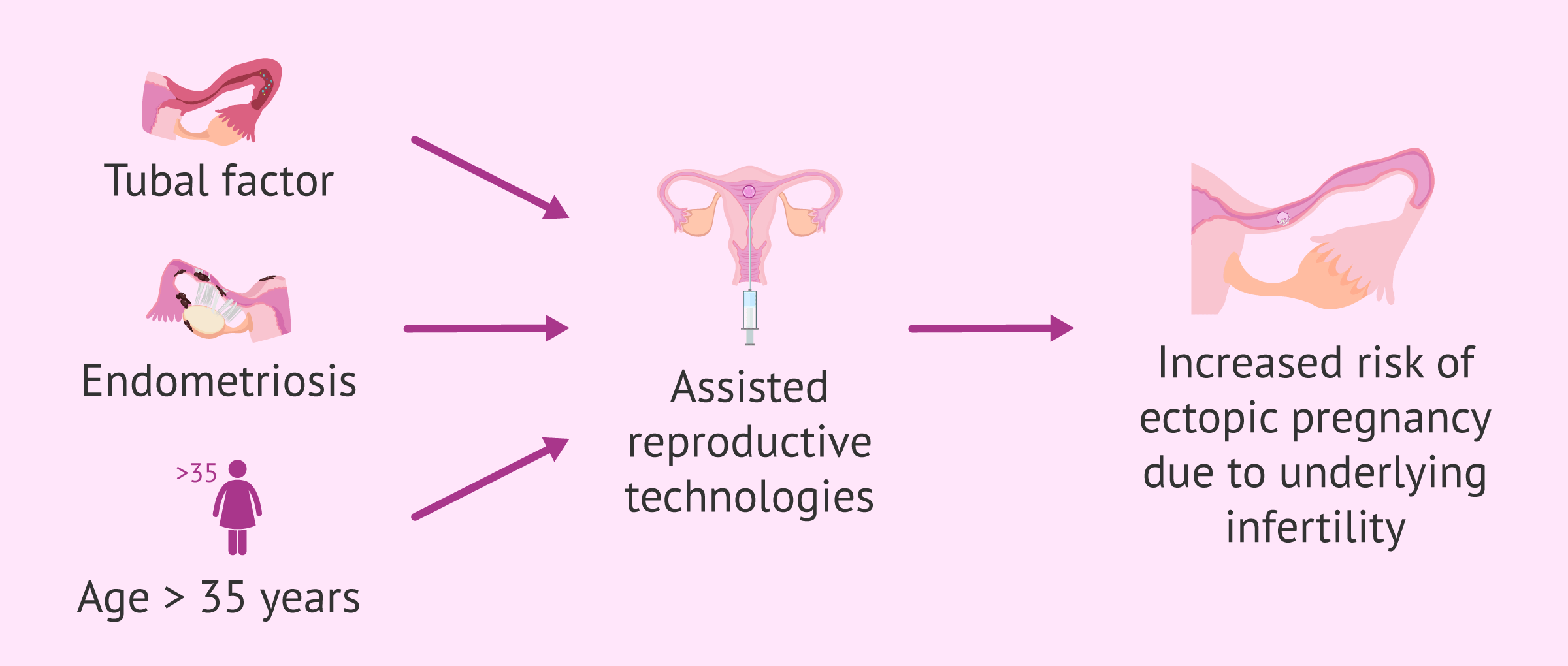Imagen: Relationship between ectopic pregnancy and assisted reproduction