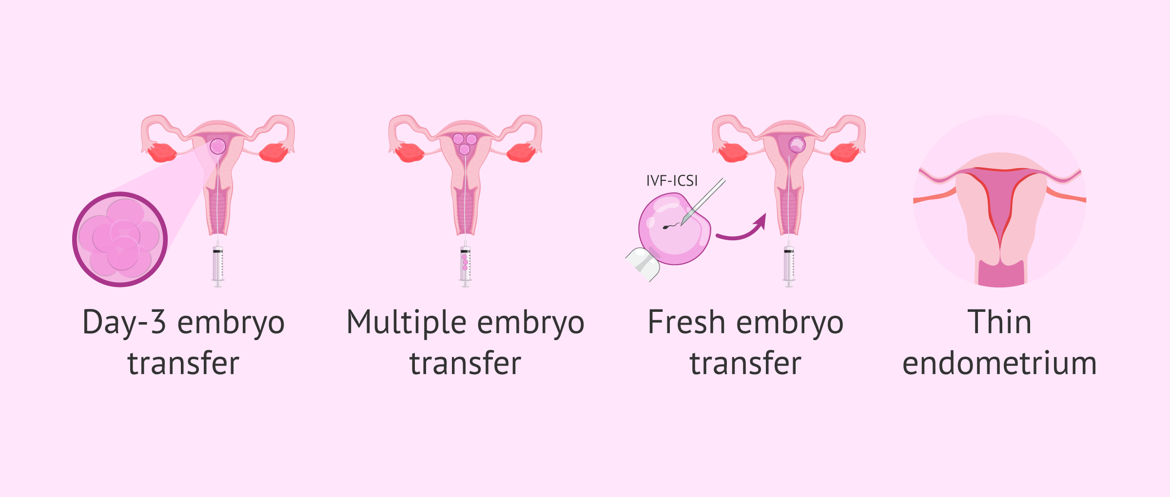 Imagen: Ectopic pregnancy and IVF