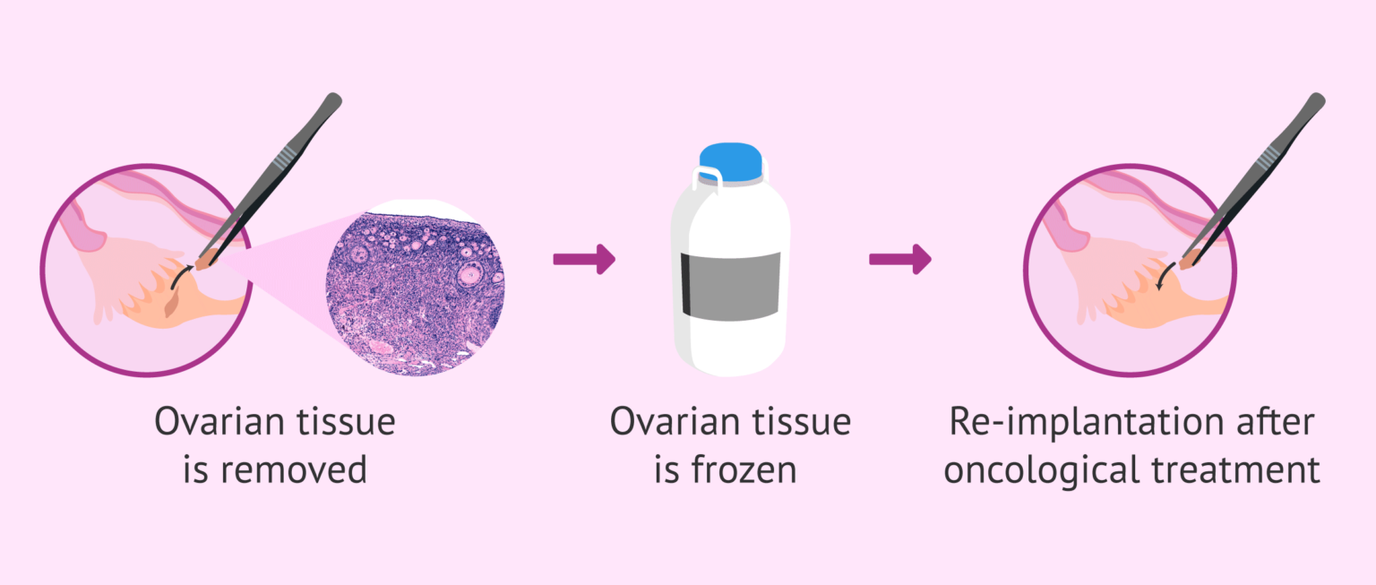 What Is Ovarian Tissue Transplantation 