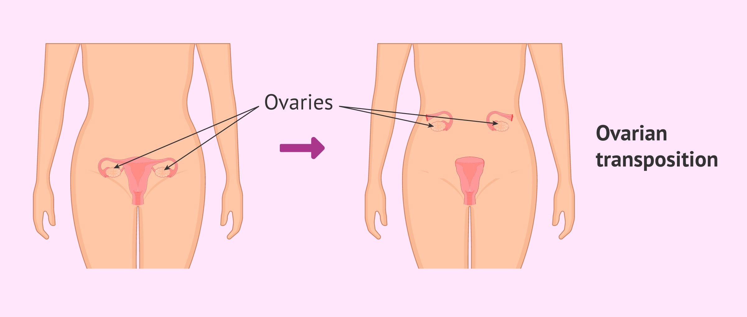 What is ovarian transposition?