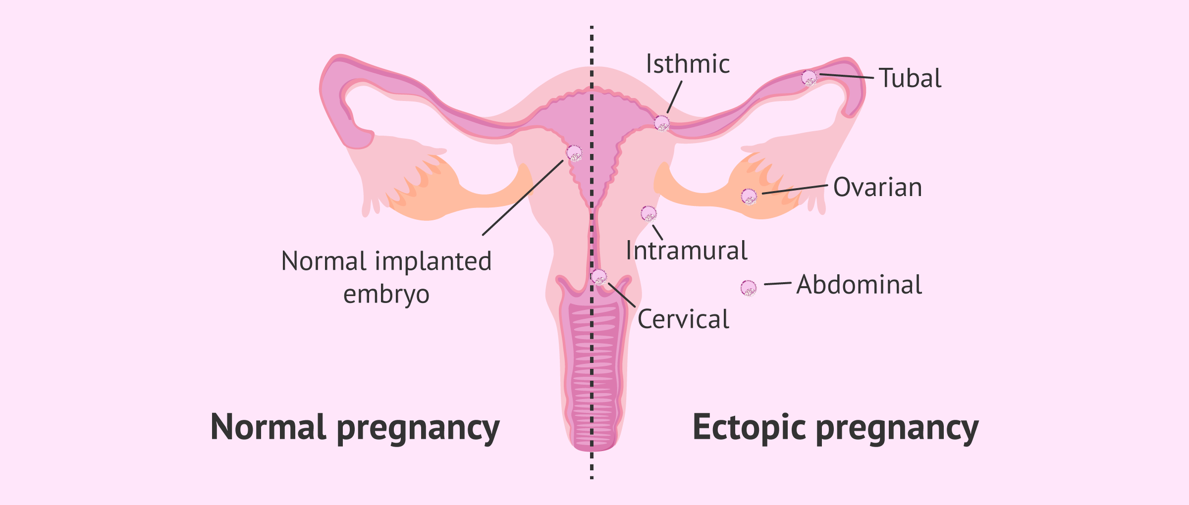 Imagen: Normal pregnancy vs ectopic pregnancy