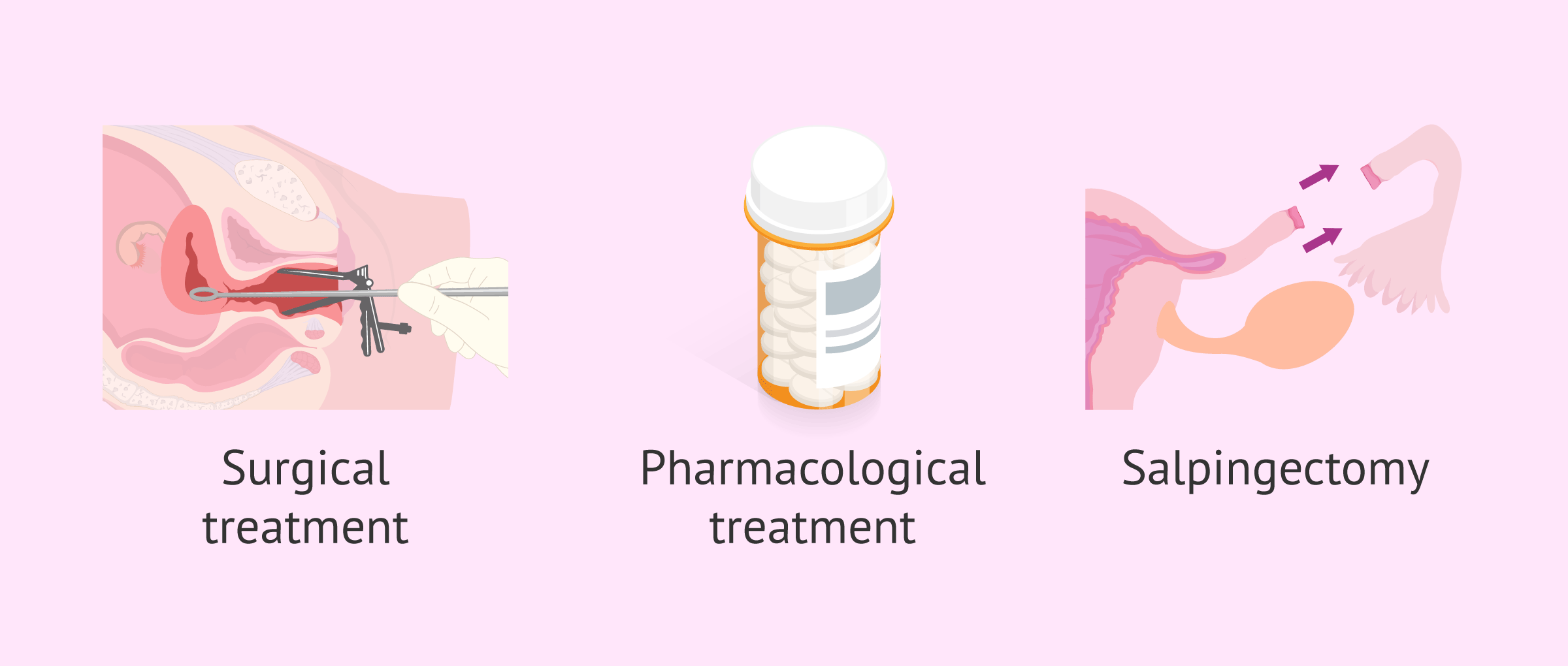 Imagen: Ways to treat an ectopic pregnancy