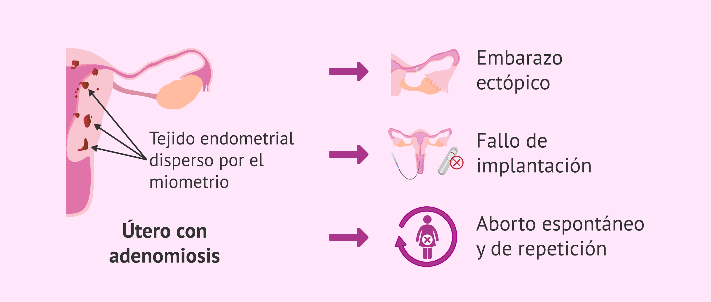 Imagen: Effects of Adenomyosis on Pregnancy
