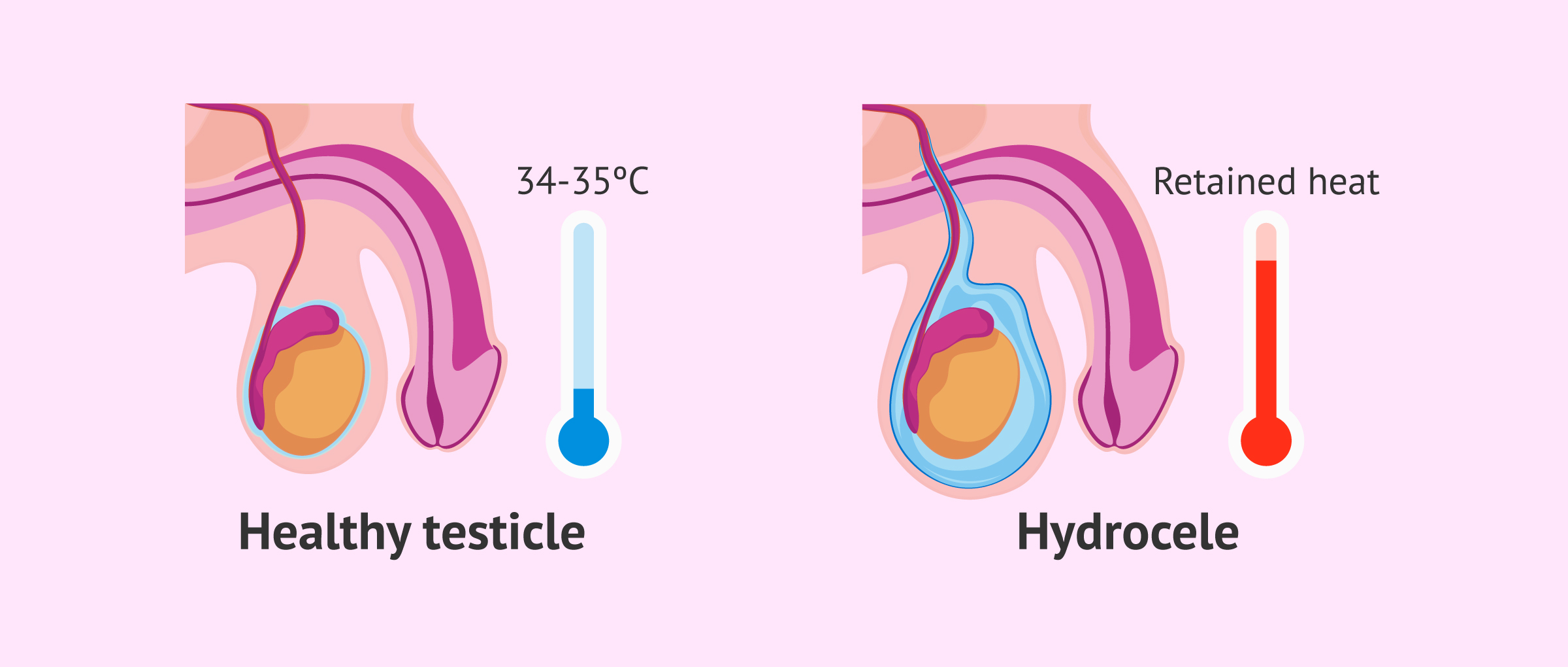Medical Myth: Does hydrocele affect male fertility?