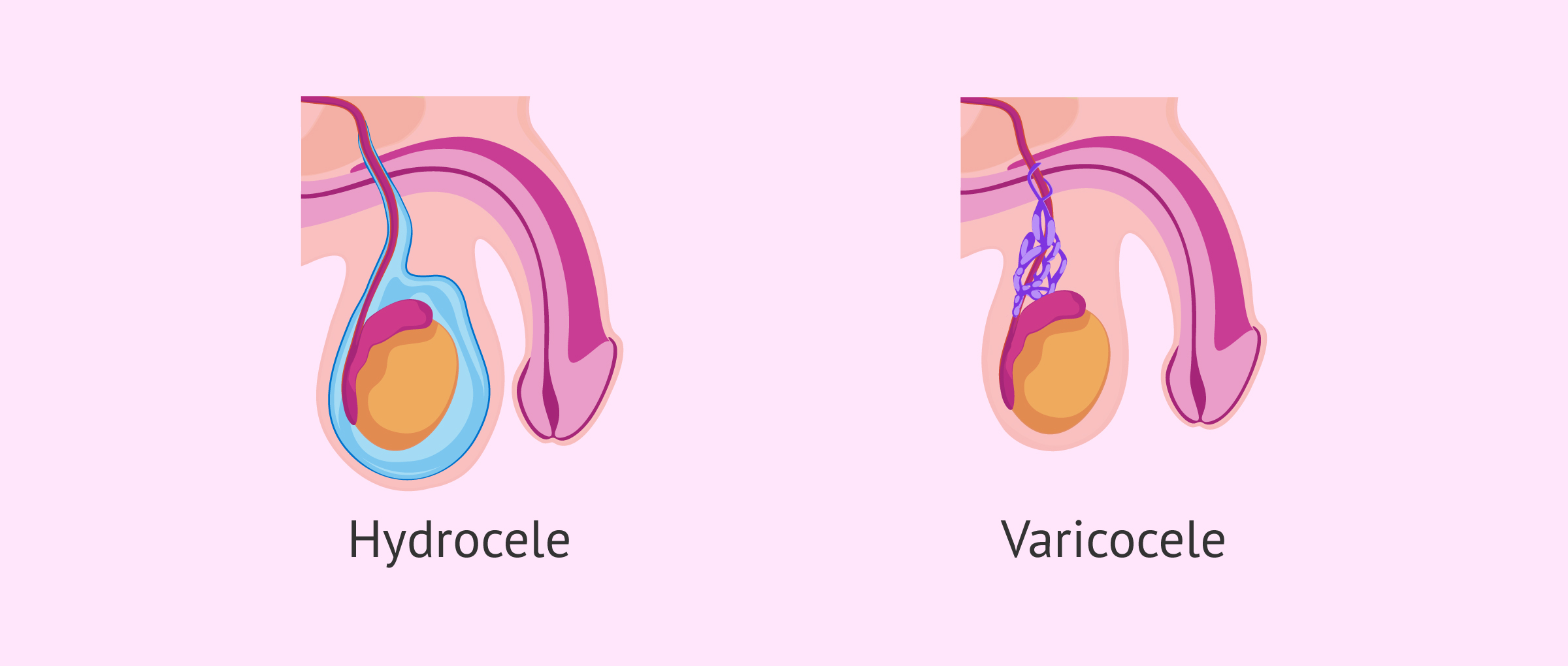 Imagen: Differences between hydrocele and varicocele
