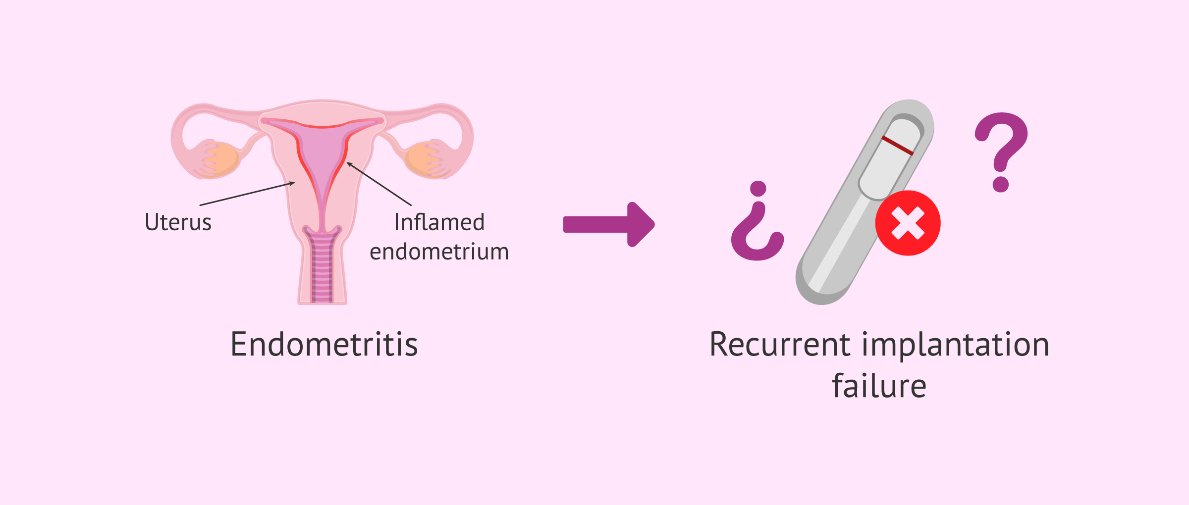 Chronic endometritis: the great truth in implantation failure