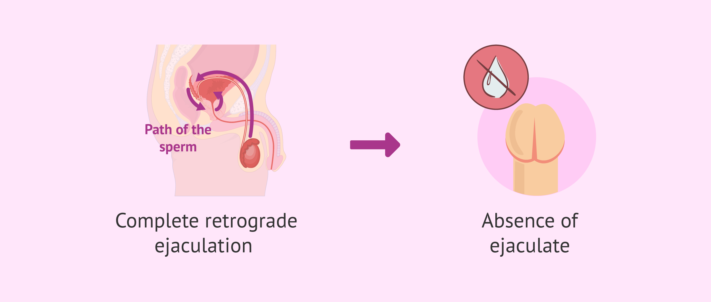 Imagen: Consequences of complete retrograde ejaculation