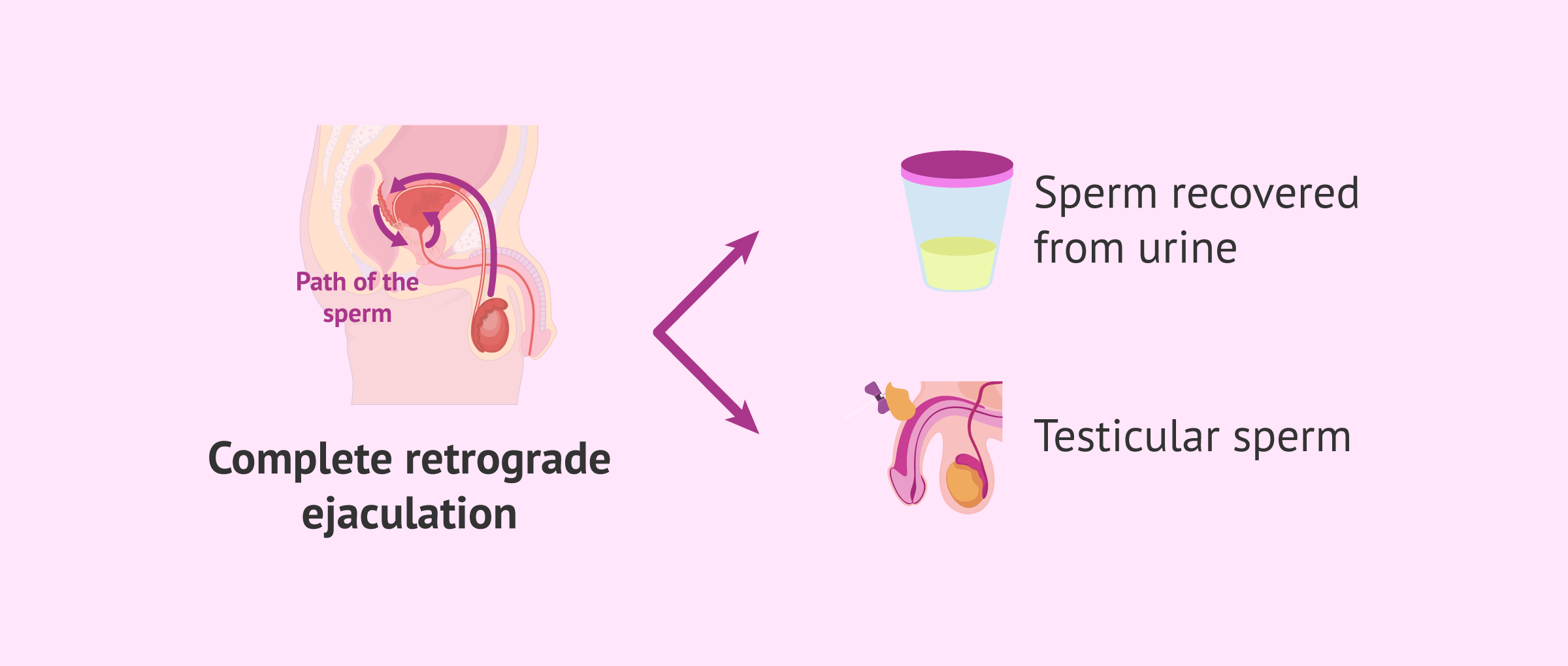 IVF with retrograde ejaculation: the secret to achieving pregnancy