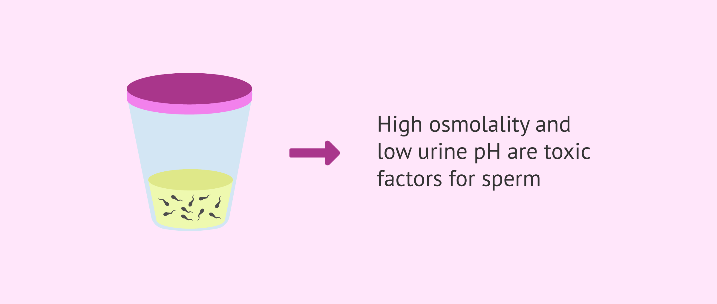 Imagen: Sperm in urine after retrograde ejaculation