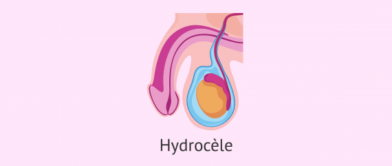 L'hydrocèle es l'accumulation de liquide entre le scrotum et le testicule