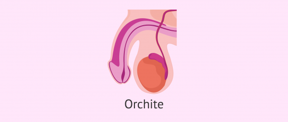 L'orchite est une pathologie testiculaire