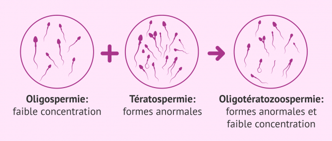 Image: Oligoteratozoospermia