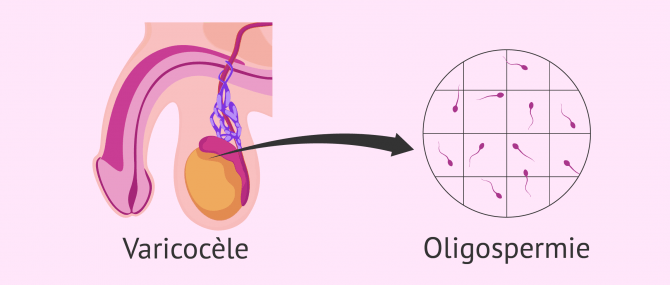 Image: Varicocele oligospermia