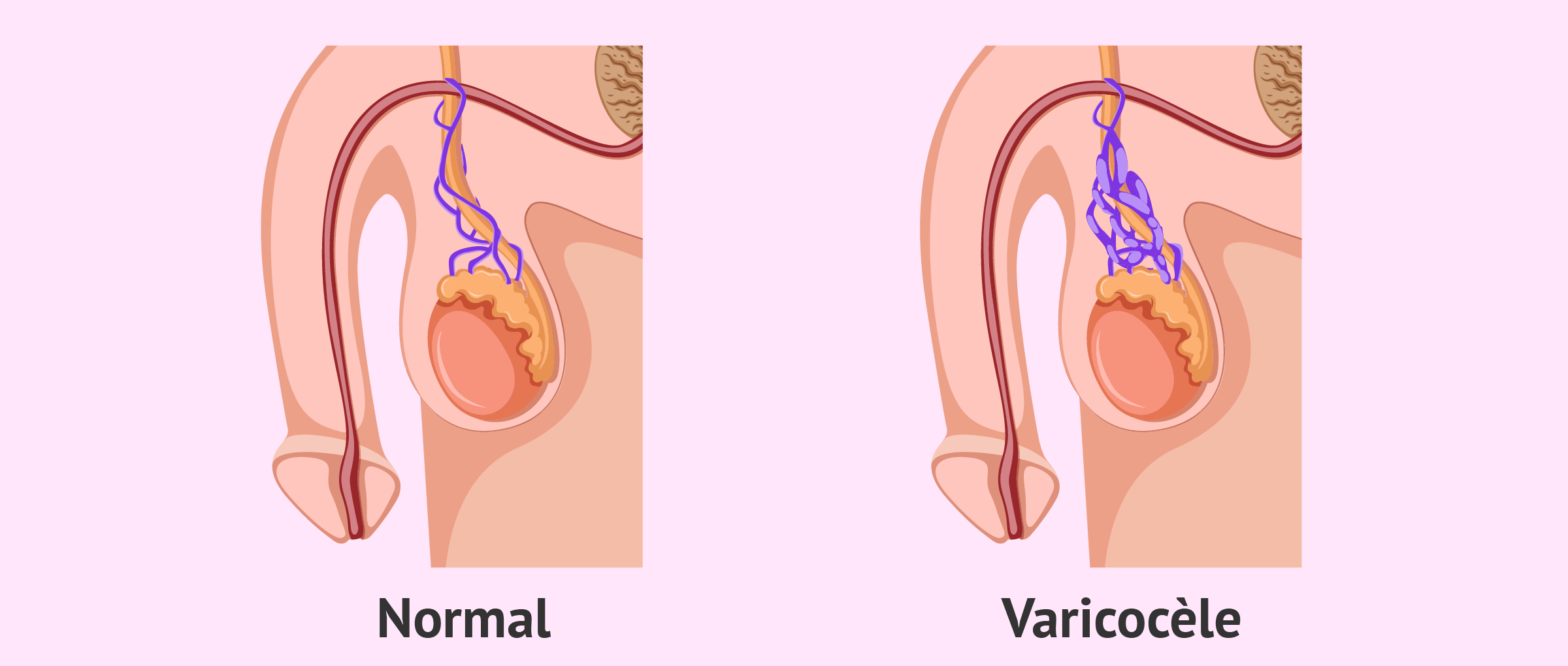 ¿Qué es el varicocele testicular?  - Causas y tratamientos