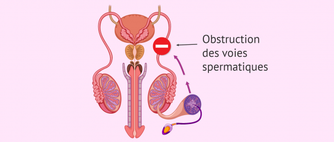 Imagen: Facteur post-testiculaire dans la stérilité masculine