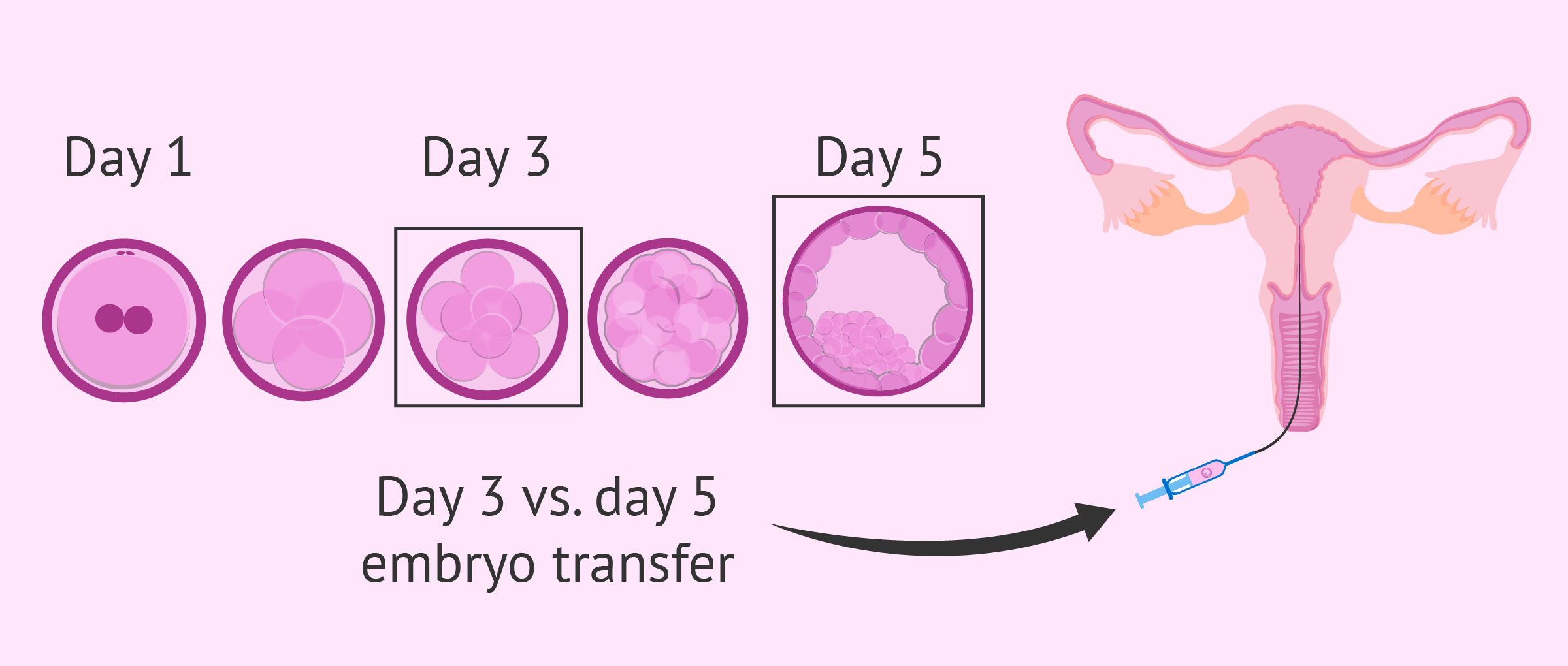 Embryo transfer on day 3 or on day 5? InviTRA