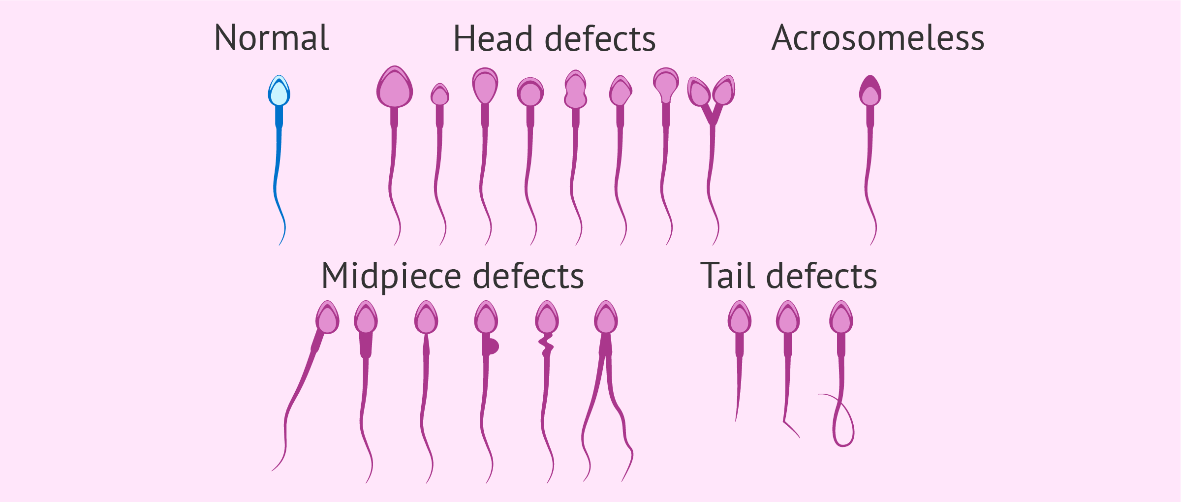 Slight abnormality in sperm