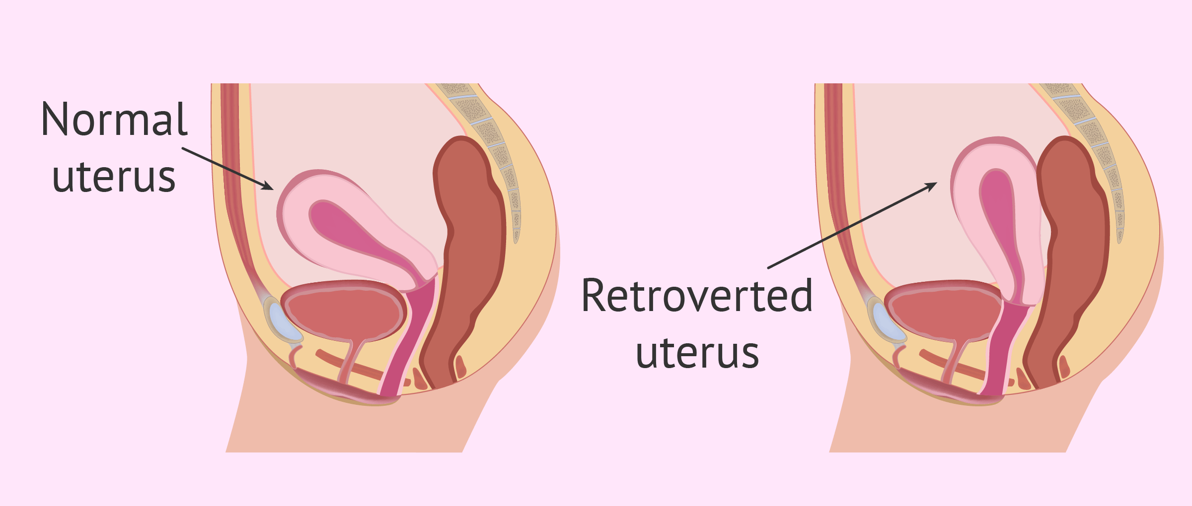 Retroverted, tilted or tipped uterus