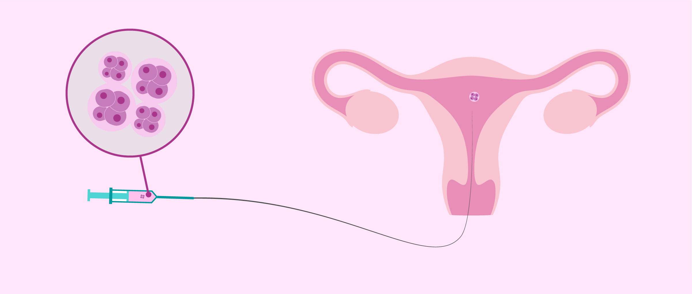 IVF Transfer Of Donated Embryos