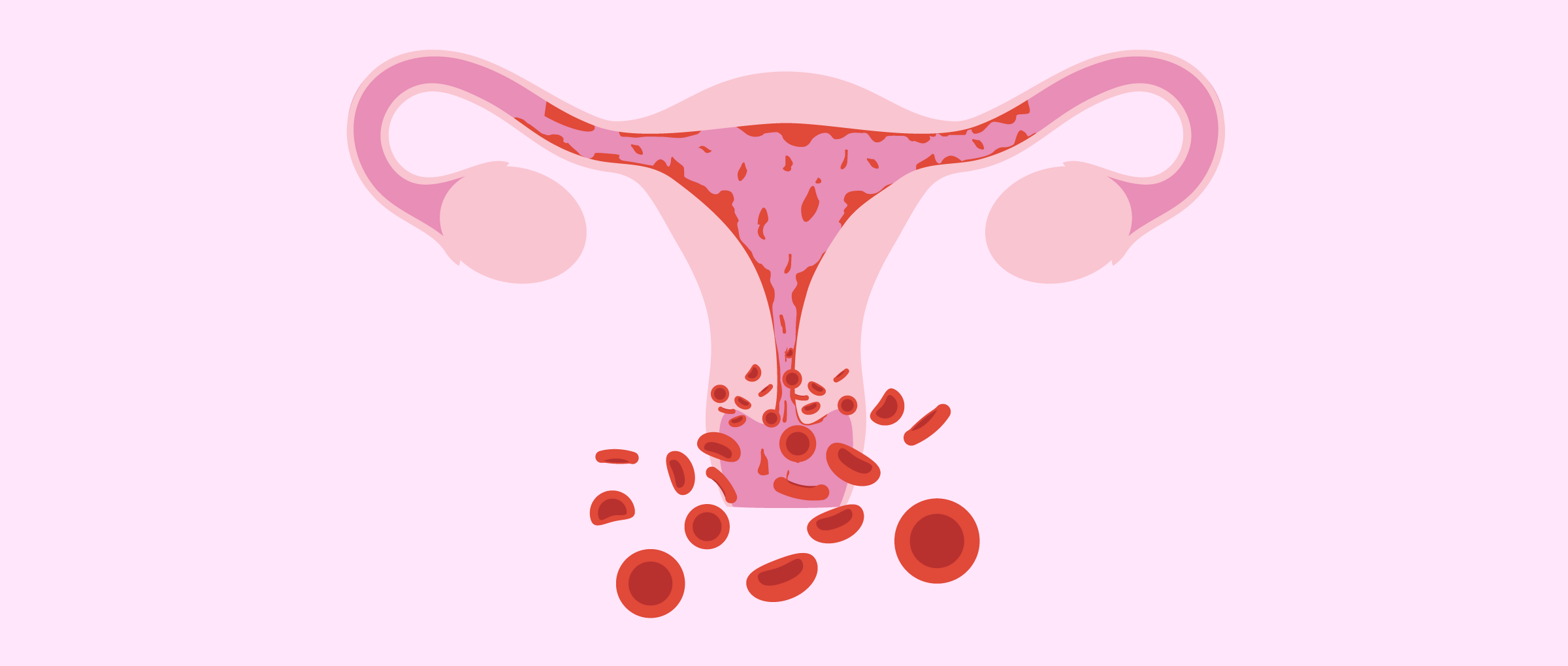 What are some medical conditions that uterine cryoablation helps?