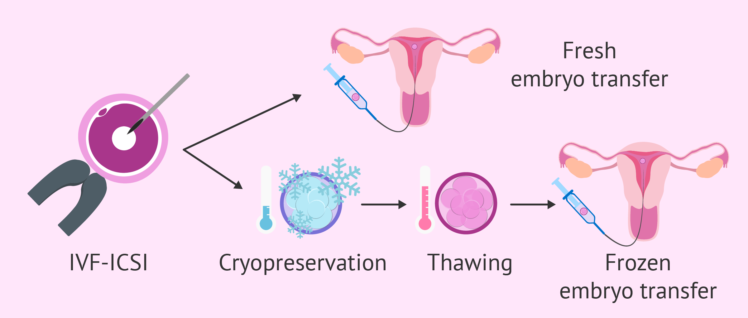 IVF with Frozen Embryo Transfer